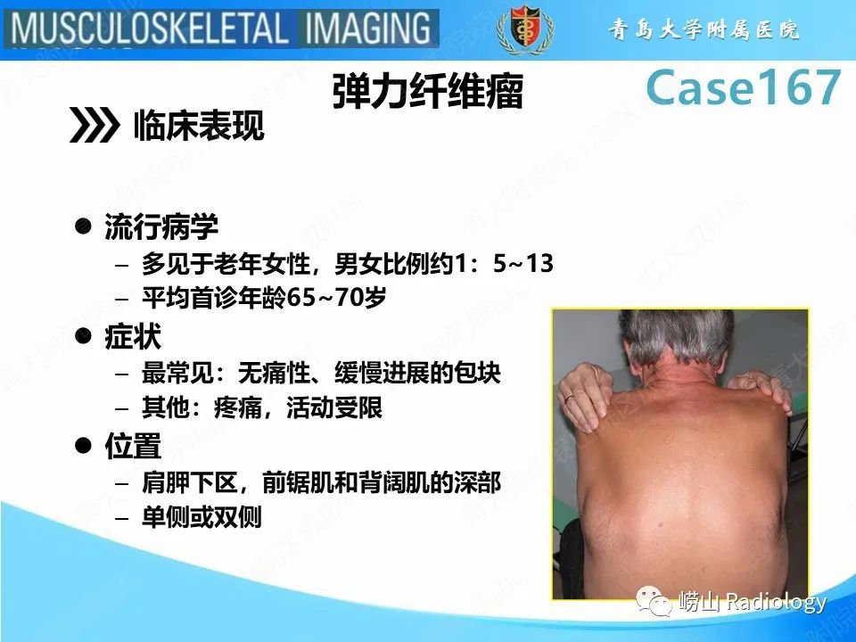 【PPT】背部弹力纤维瘤-12