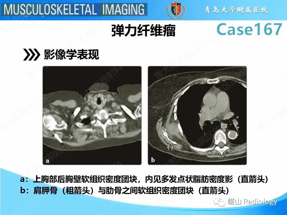 【PPT】背部弹力纤维瘤-15