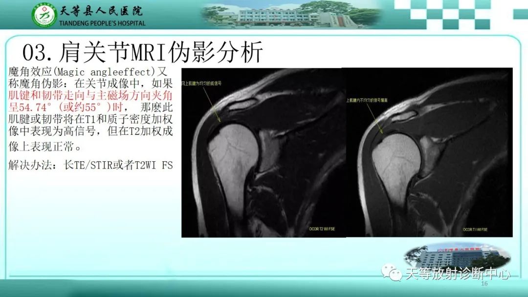 【PPT】肩关节MRI扫描技术-16