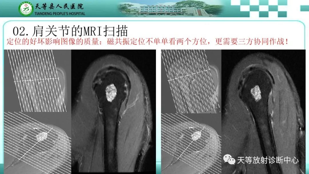 【PPT】肩关节MRI扫描技术-6
