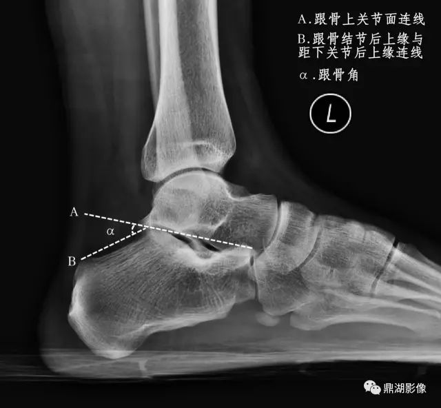 扁平足X线测量方法-2 扁平足X线测量方法-2