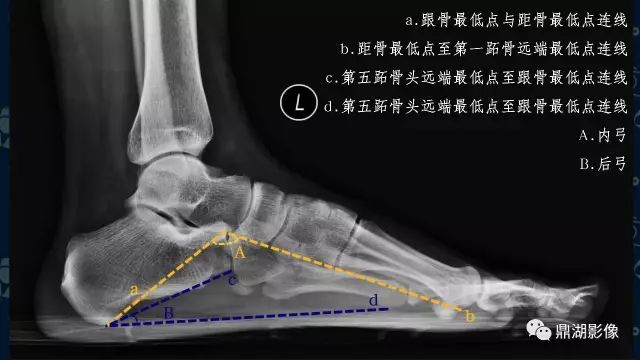 扁平足X线测量方法-7 扁平足X线测量方法-7