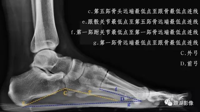 扁平足X线测量方法-8 扁平足X线测量方法-8