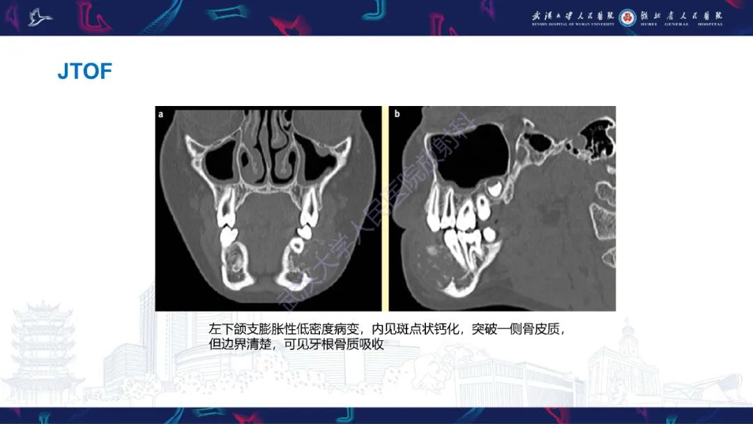 【PPT】颌面部骨化性纤维瘤影像诊断-18