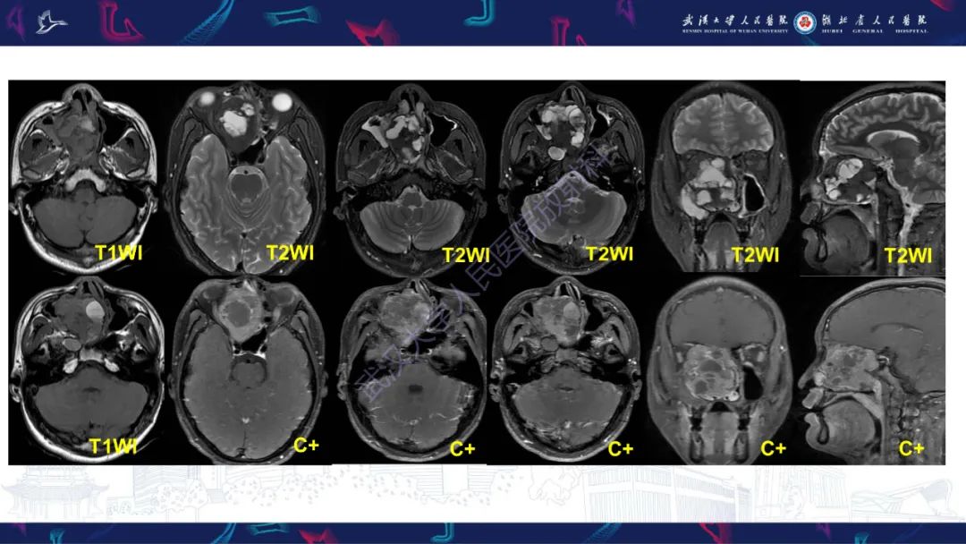 【PPT】颌面部骨化性纤维瘤影像诊断-4