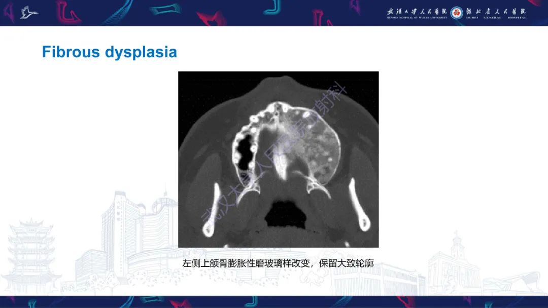 【PPT】颌面部骨化性纤维瘤影像诊断-27