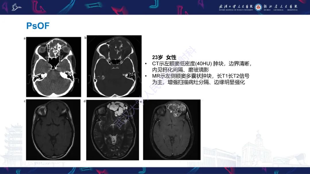 【PPT】颌面部骨化性纤维瘤影像诊断-21