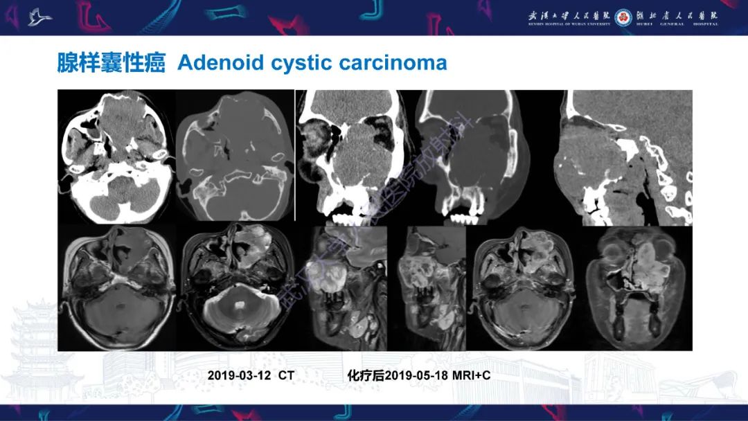 【PPT】颌面部骨化性纤维瘤影像诊断-38