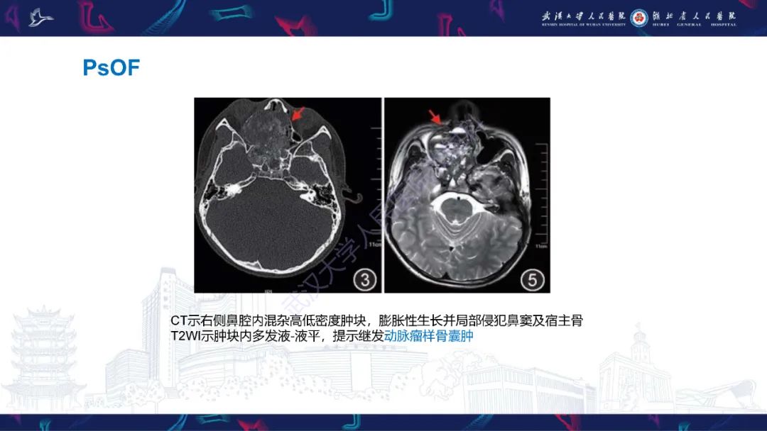 【PPT】颌面部骨化性纤维瘤影像诊断-22