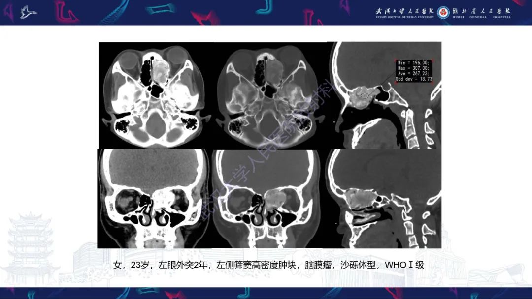 【PPT】颌面部骨化性纤维瘤影像诊断-34