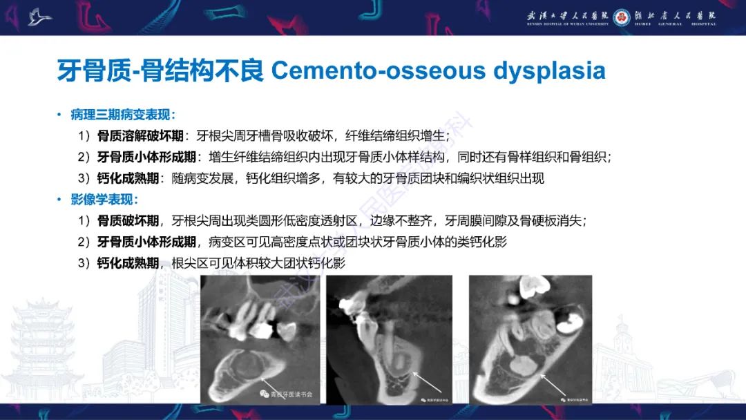 【PPT】颌面部骨化性纤维瘤影像诊断-30