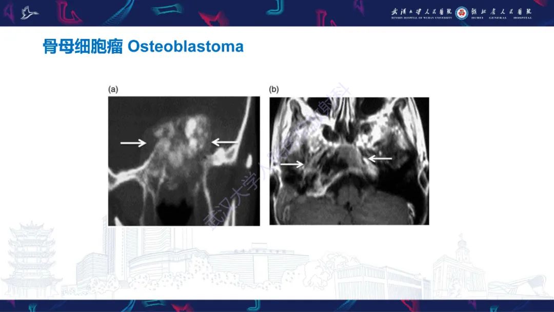 【PPT】颌面部骨化性纤维瘤影像诊断-35