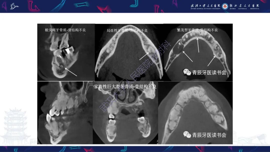 【PPT】颌面部骨化性纤维瘤影像诊断-29