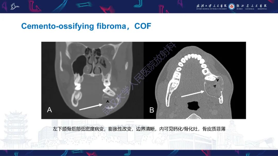 【PPT】颌面部骨化性纤维瘤影像诊断-14