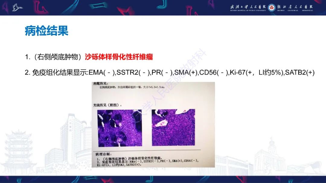 【PPT】颌面部骨化性纤维瘤影像诊断-6