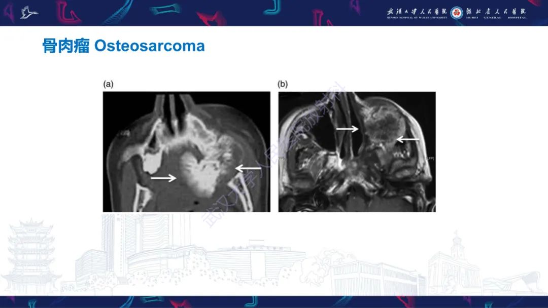 【PPT】颌面部骨化性纤维瘤影像诊断-36