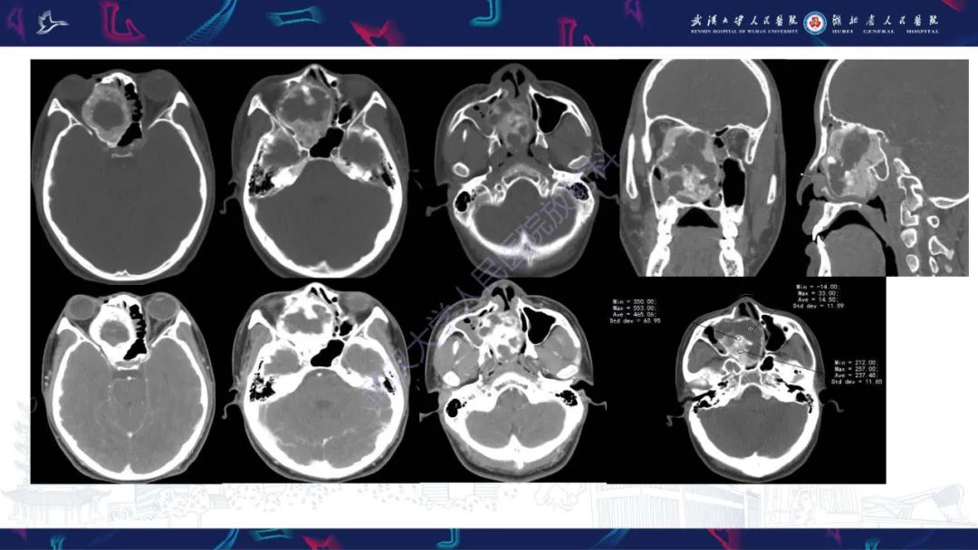 【PPT】颌面部骨化性纤维瘤影像诊断-3