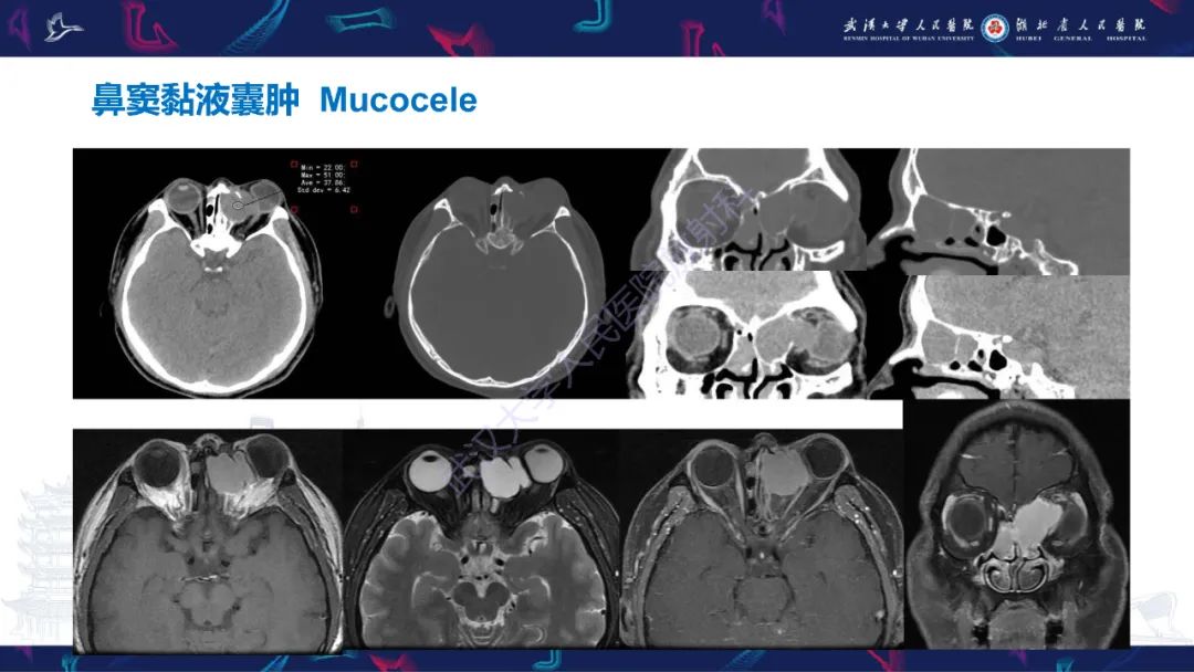 【PPT】颌面部骨化性纤维瘤影像诊断-37