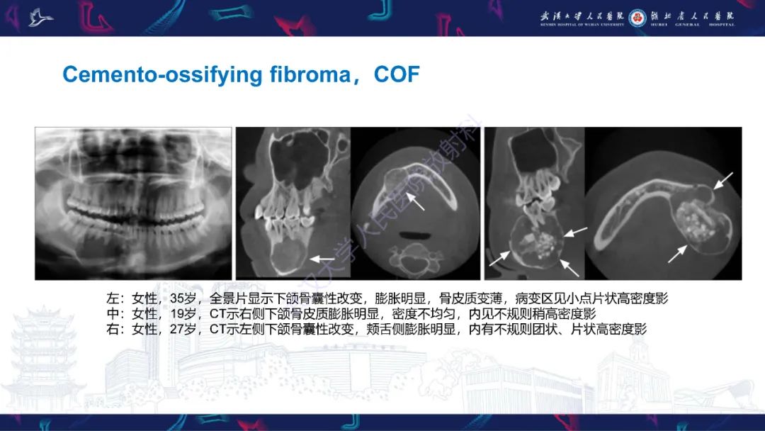 【PPT】颌面部骨化性纤维瘤影像诊断-15