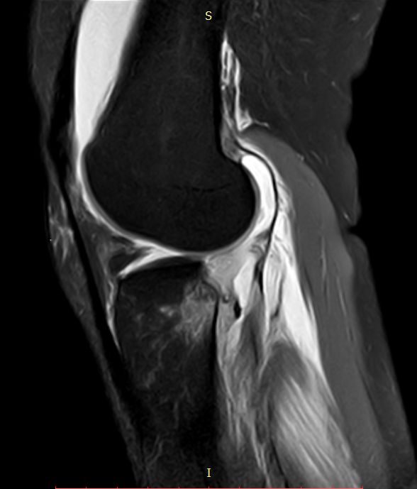 【病例】Segond骨折前交叉韧带损伤1例MR-21 【病例】Segond骨折前交叉韧带损伤1例MR-21