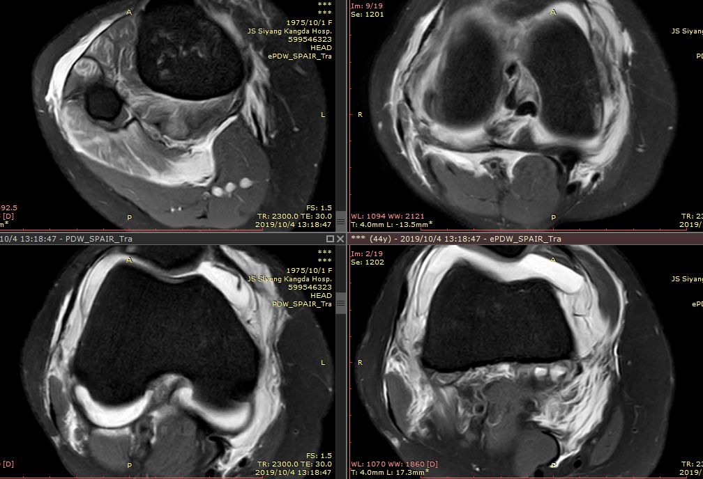 【病例】Segond骨折前交叉韧带损伤1例MR-12 【病例】Segond骨折前交叉韧带损伤1例MR-12