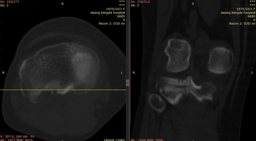 【病例】Segond骨折前交叉韧带损伤1例MR-3 【病例】Segond骨折前交叉韧带损伤1例MR-3