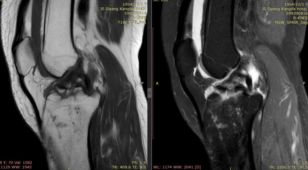 【病例】Segond骨折前交叉韧带损伤1例MR-19 【病例】Segond骨折前交叉韧带损伤1例MR-19
