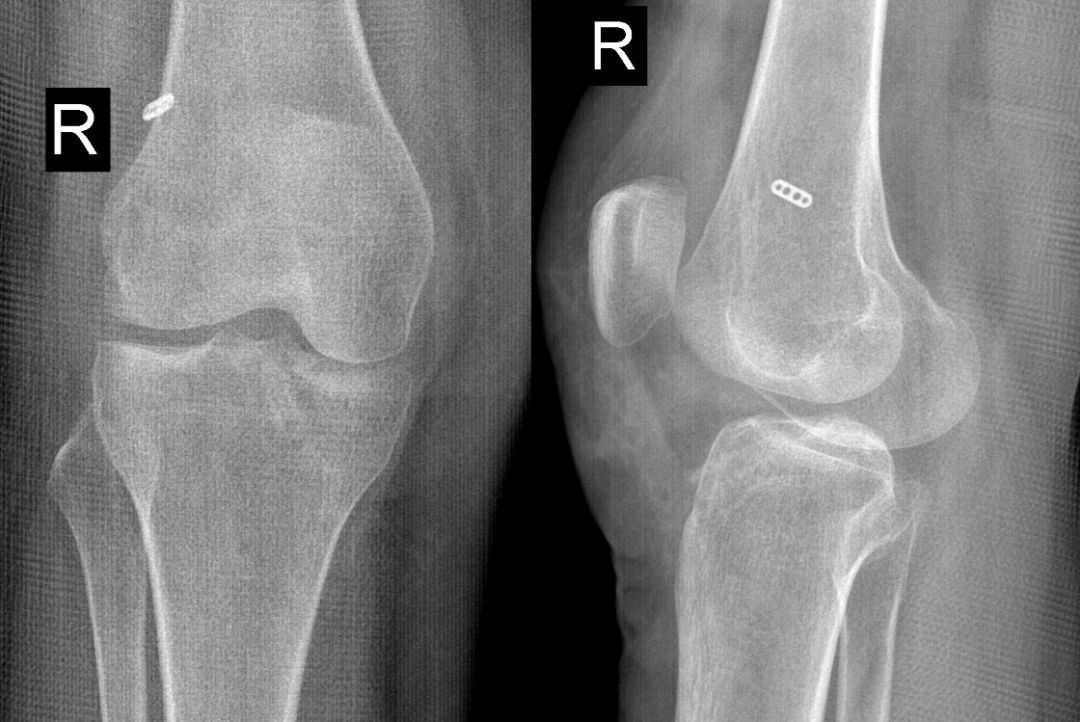 【病例】Segond骨折前交叉韧带损伤1例MR-16 【病例】Segond骨折前交叉韧带损伤1例MR-16