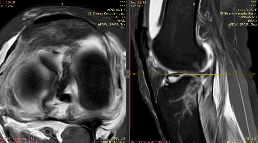 【病例】Segond骨折前交叉韧带损伤1例MR-8 【病例】Segond骨折前交叉韧带损伤1例MR-8