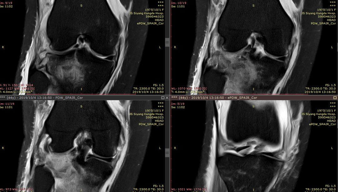 【病例】Segond骨折前交叉韧带损伤1例MR-10 【病例】Segond骨折前交叉韧带损伤1例MR-10