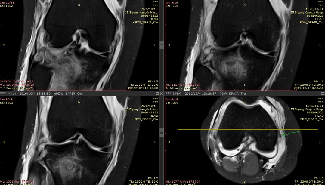【病例】Segond骨折前交叉韧带损伤1例MR-11 【病例】Segond骨折前交叉韧带损伤1例MR-11