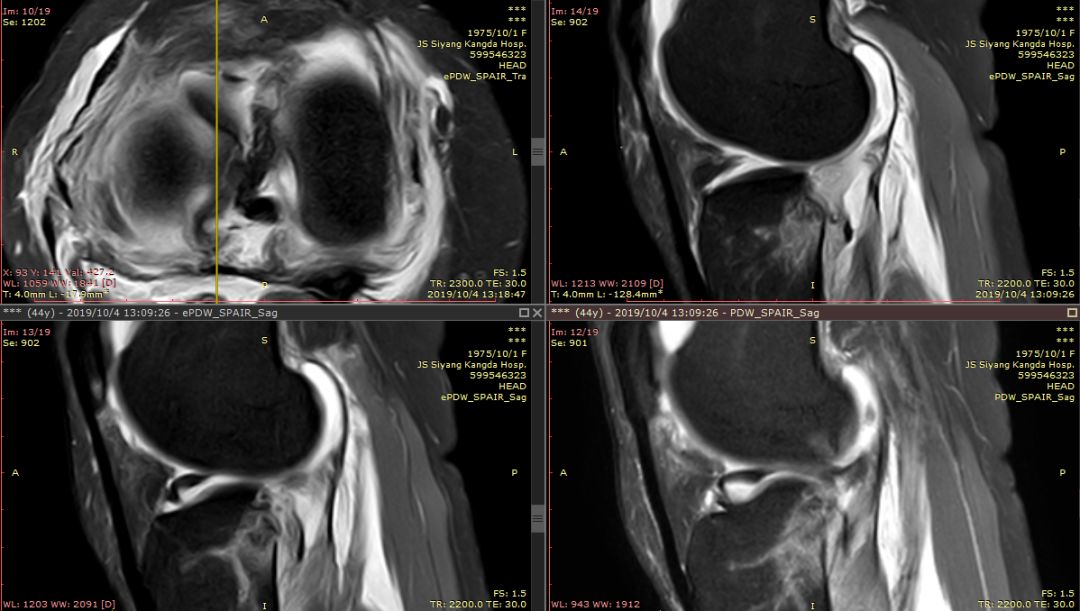 【病例】Segond骨折前交叉韧带损伤1例MR-9 【病例】Segond骨折前交叉韧带损伤1例MR-9