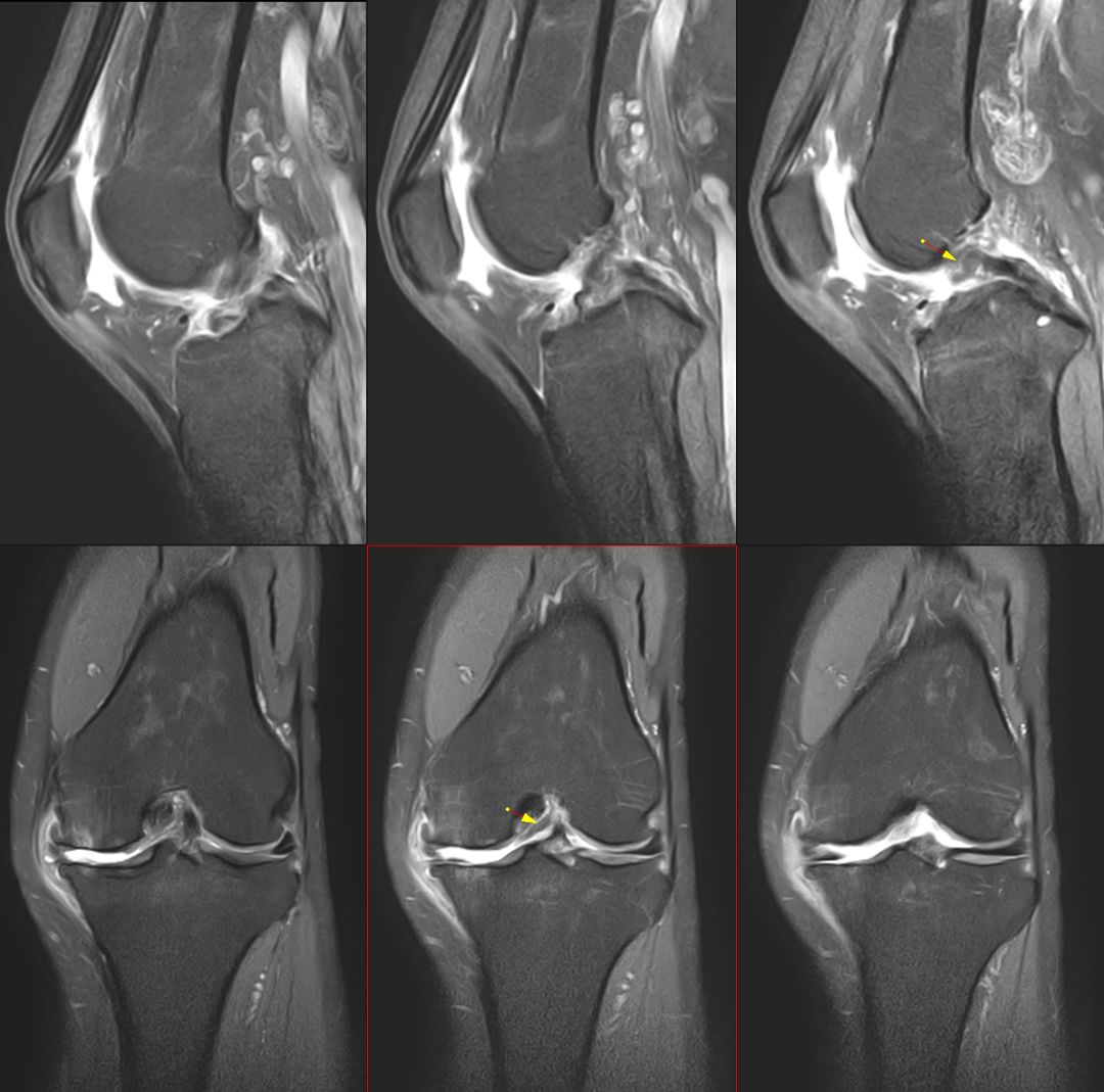 【病例】Segond骨折前交叉韧带损伤1例MR-24 【病例】Segond骨折前交叉韧带损伤1例MR-24