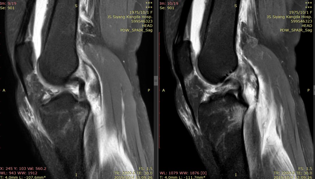 【病例】Segond骨折前交叉韧带损伤1例MR-4 【病例】Segond骨折前交叉韧带损伤1例MR-4