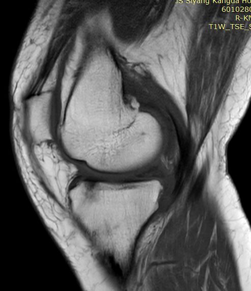 【病例】Segond骨折前交叉韧带损伤1例MR-22 【病例】Segond骨折前交叉韧带损伤1例MR-22