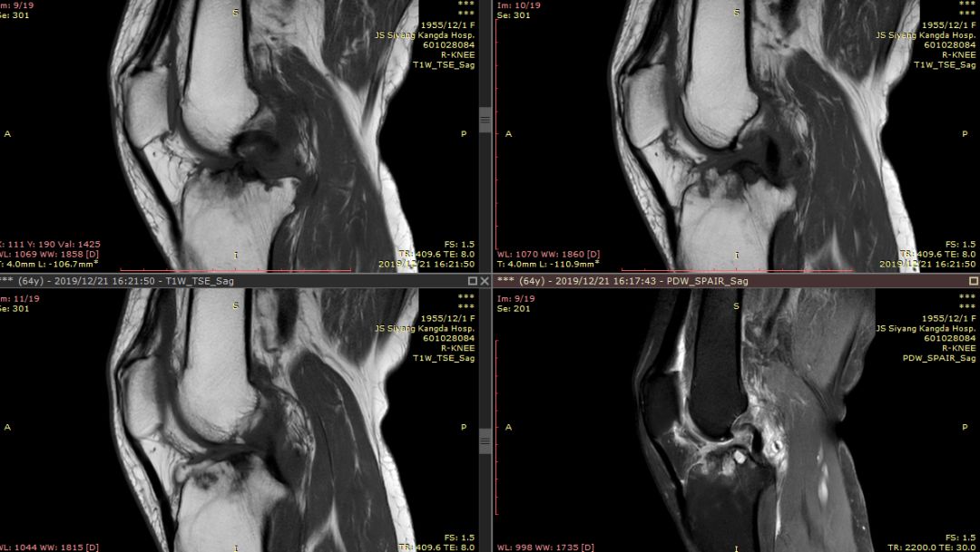 【病例】Segond骨折前交叉韧带损伤1例MR-17 【病例】Segond骨折前交叉韧带损伤1例MR-17