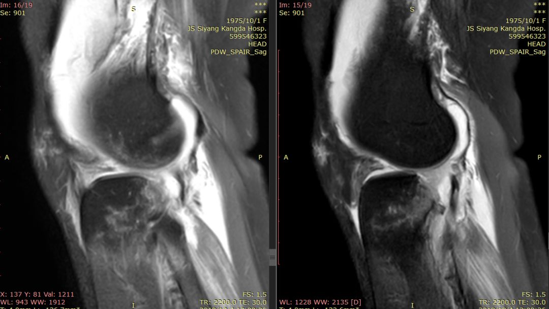【病例】Segond骨折前交叉韧带损伤1例MR-5 【病例】Segond骨折前交叉韧带损伤1例MR-5