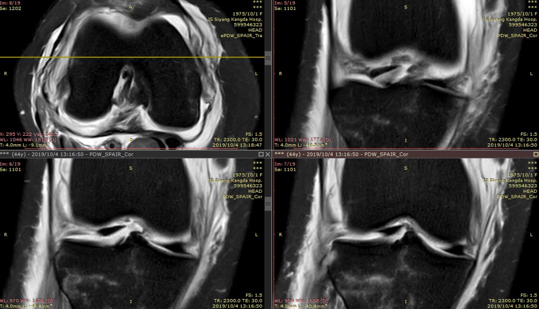 【病例】Segond骨折前交叉韧带损伤1例MR-6 【病例】Segond骨折前交叉韧带损伤1例MR-6