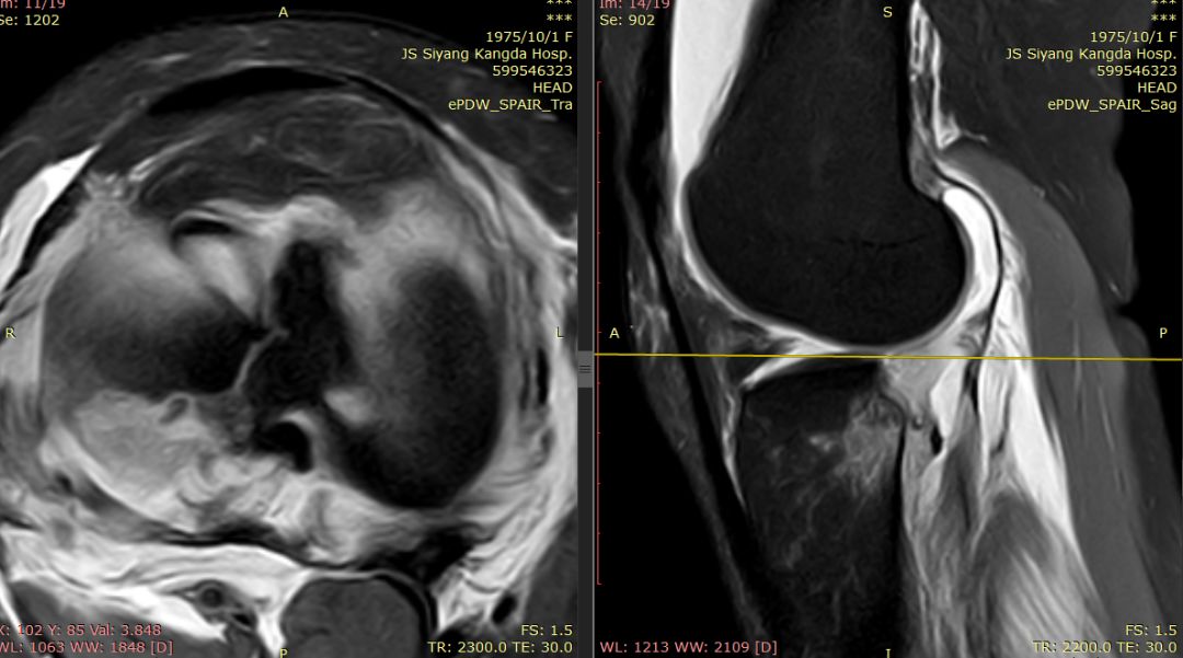 【病例】Segond骨折前交叉韧带损伤1例MR-7 【病例】Segond骨折前交叉韧带损伤1例MR-7