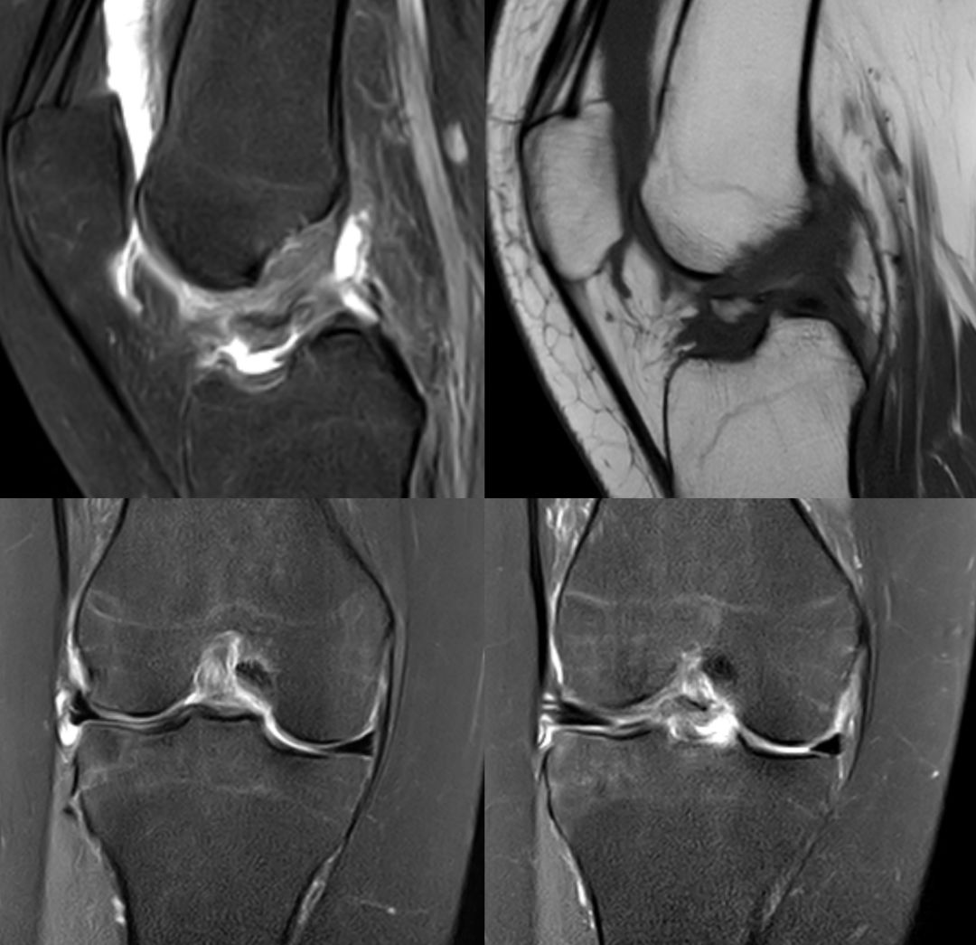 【病例】Segond骨折前交叉韧带损伤1例MR-14 【病例】Segond骨折前交叉韧带损伤1例MR-14