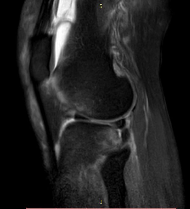【病例】Segond骨折前交叉韧带损伤1例MR-23 【病例】Segond骨折前交叉韧带损伤1例MR-23