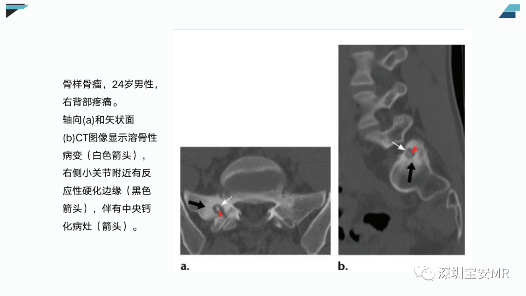 【PPT】椎小关节常见病变的影像表现-30