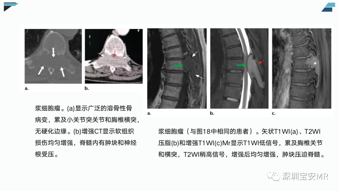 【PPT】椎小关节常见病变的影像表现-33