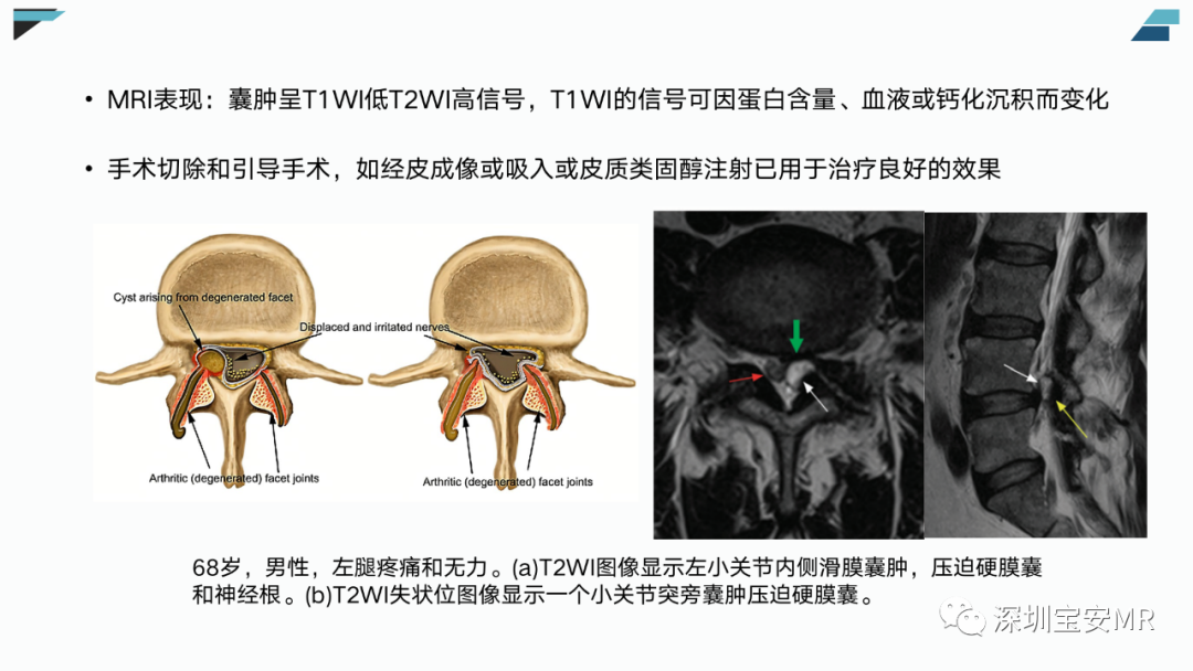 【PPT】椎小关节常见病变的影像表现-12