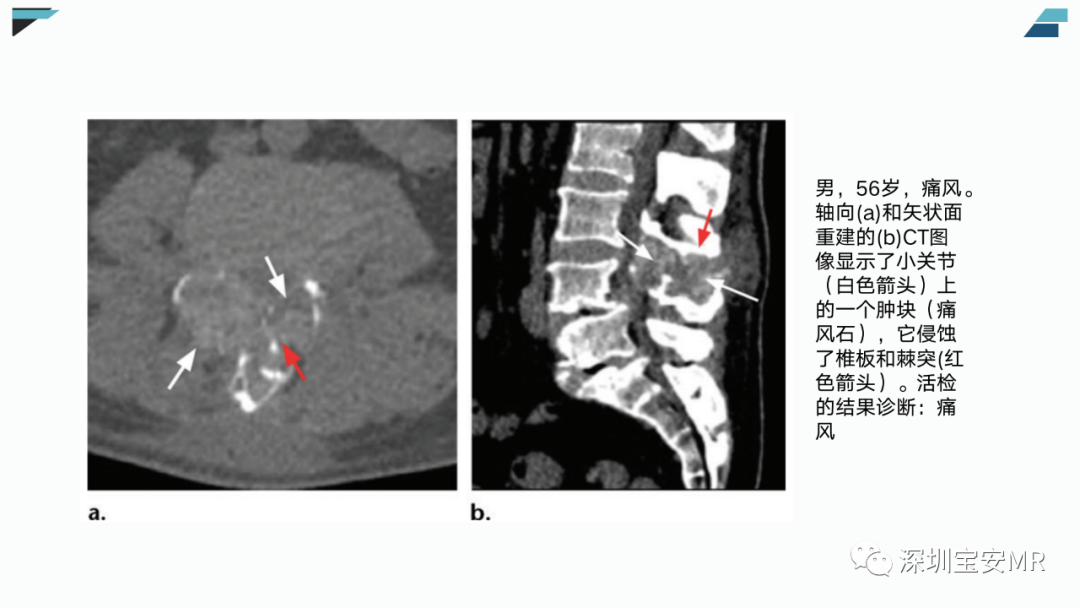 【PPT】椎小关节常见病变的影像表现-22