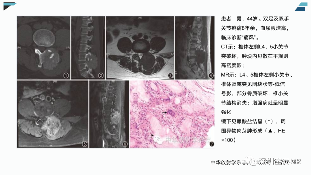 【PPT】椎小关节常见病变的影像表现-23