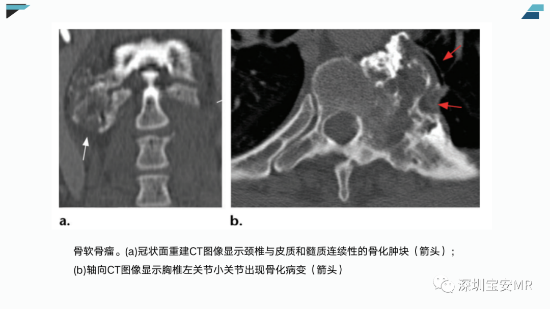 【PPT】椎小关节常见病变的影像表现-39