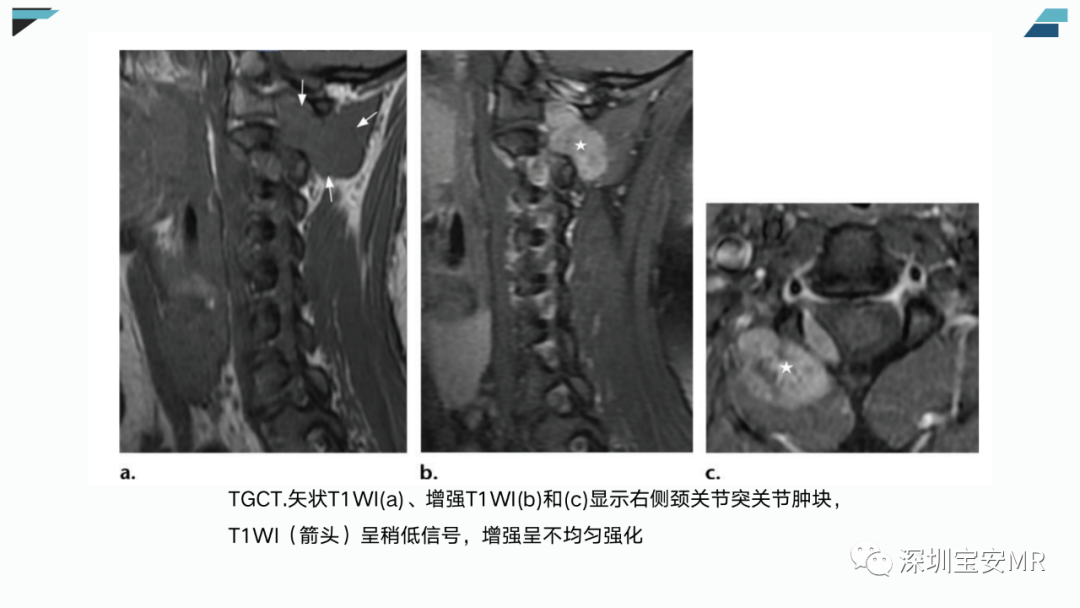 【PPT】椎小关节常见病变的影像表现-36
