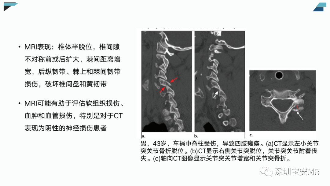 【PPT】椎小关节常见病变的影像表现-27