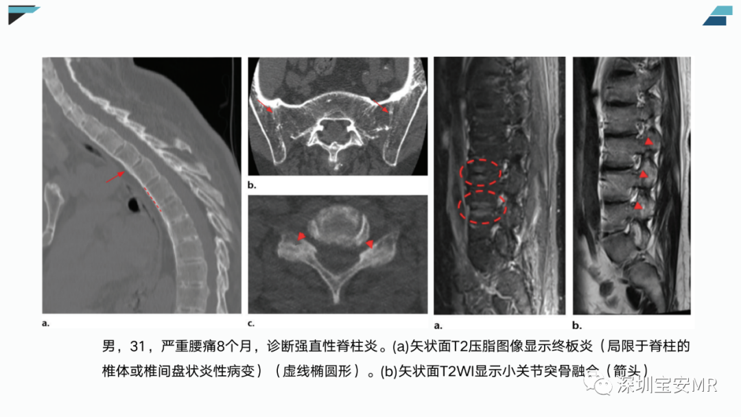 【PPT】椎小关节常见病变的影像表现-16